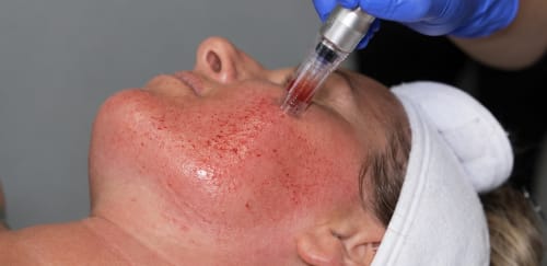 October Microneedling Special
