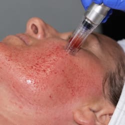 October Microneedling Special